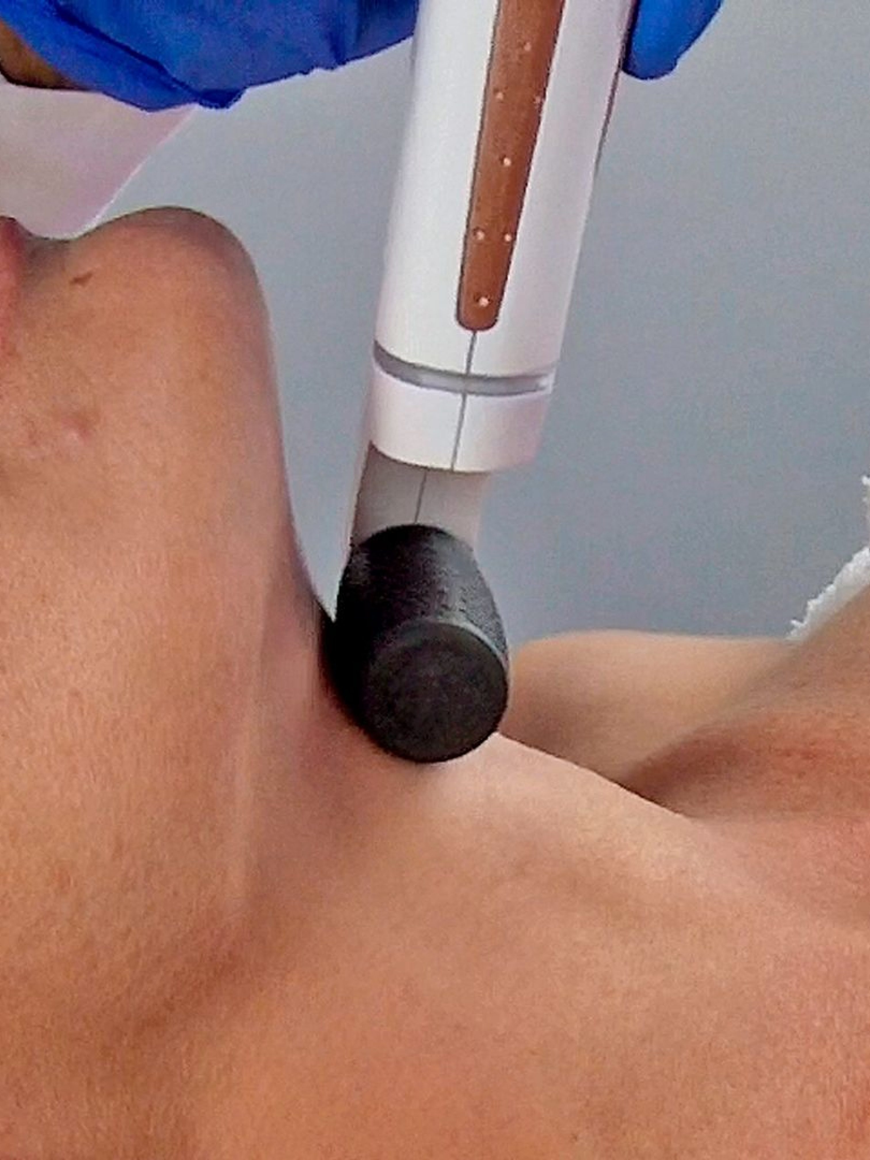 Plasma Skin Rejuvenation thumbnail